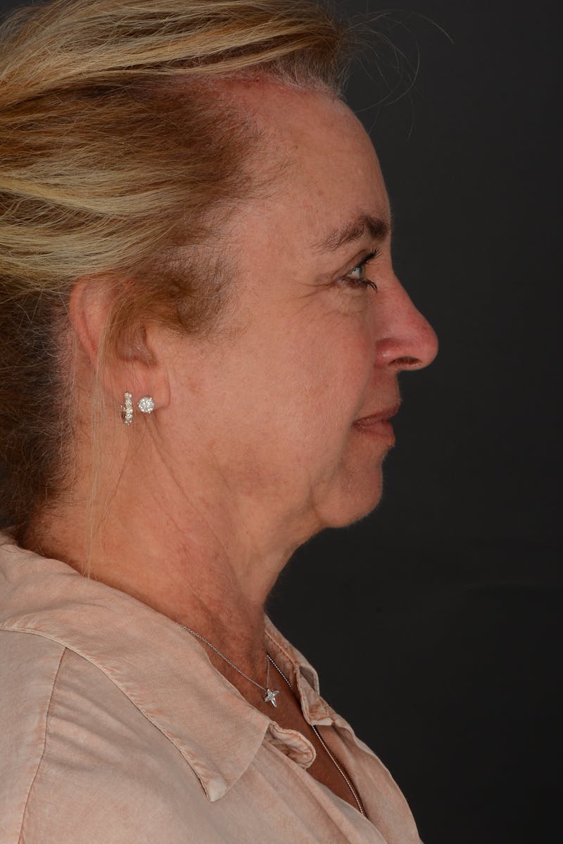 Brow Lift Before & After Gallery - Patient 157802 - Image 6