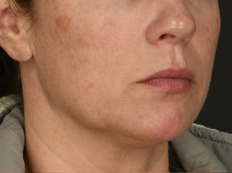 Laser Resurfacing Before & After Gallery - Patient 119012 - Image 1