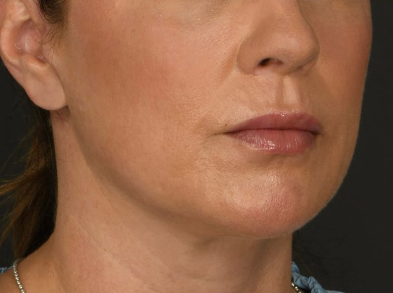 Laser Resurfacing Before & After Gallery - Patient 119012 - Image 2