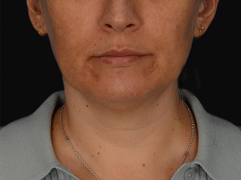Chin Augmentation Before & After Gallery - Patient 356159 - Image 1
