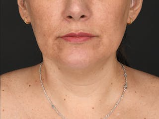 Chin Augmentation Before & After Gallery - Patient 356159 - Image 2