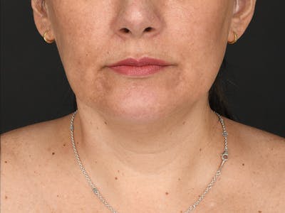 Chin Augmentation Before & After Gallery - Patient 356159 - Image 2