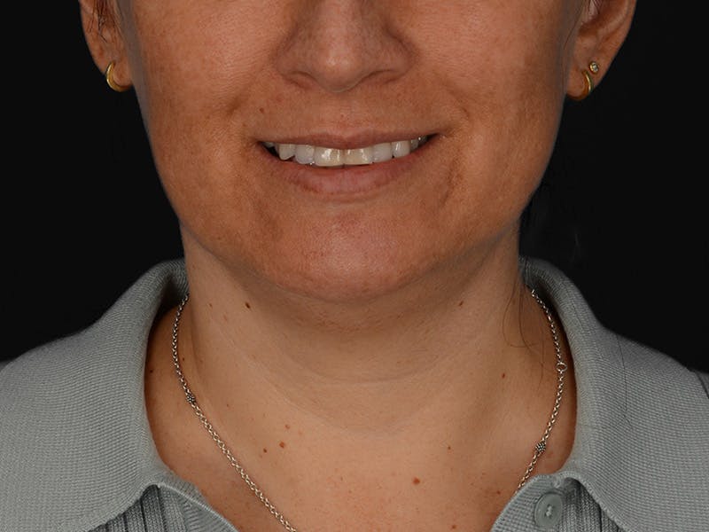 Chin Augmentation Before & After Gallery - Patient 356159 - Image 3