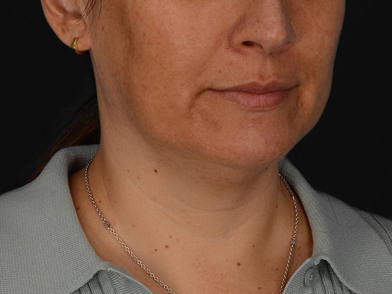 Chin Augmentation Before & After Gallery - Patient 356159 - Image 5