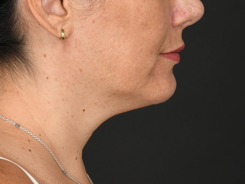 Chin Augmentation Before & After Gallery - Patient 356159 - Image 8
