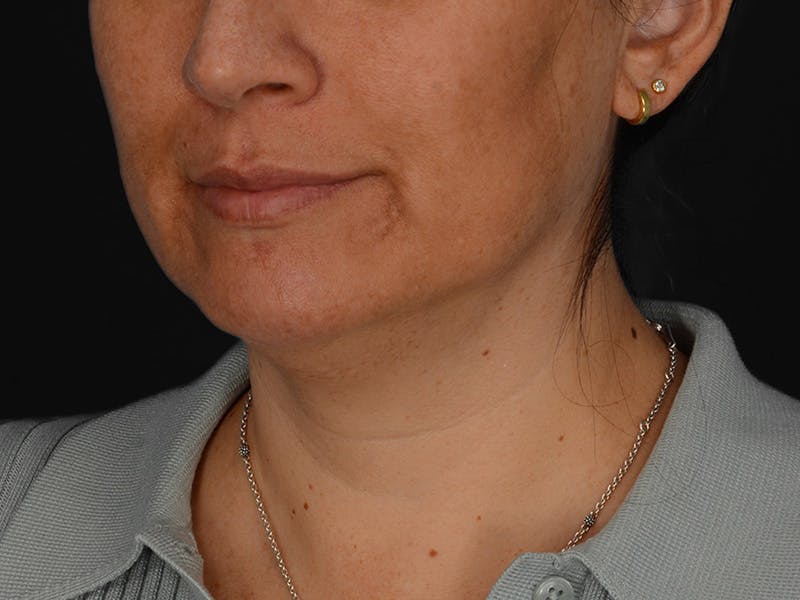 Chin Augmentation Before & After Gallery - Patient 356159 - Image 9