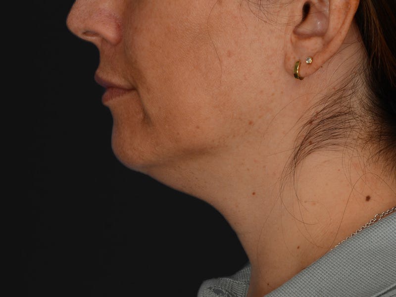 Chin Augmentation Before & After Gallery - Patient 356159 - Image 11