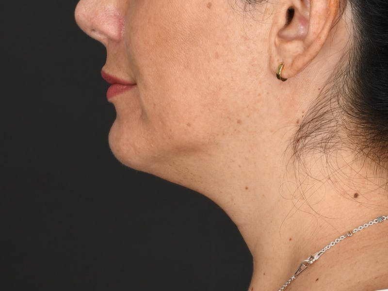 Chin Augmentation Before & After Gallery - Patient 356159 - Image 12