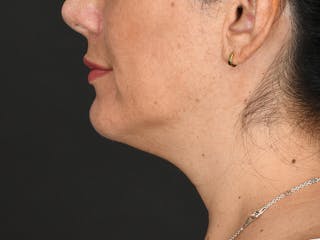 Chin Augmentation Before & After Gallery - Patient 356159 - Image 12