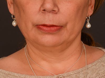 Chin Augmentation Before & After Gallery - Patient 204268 - Image 1