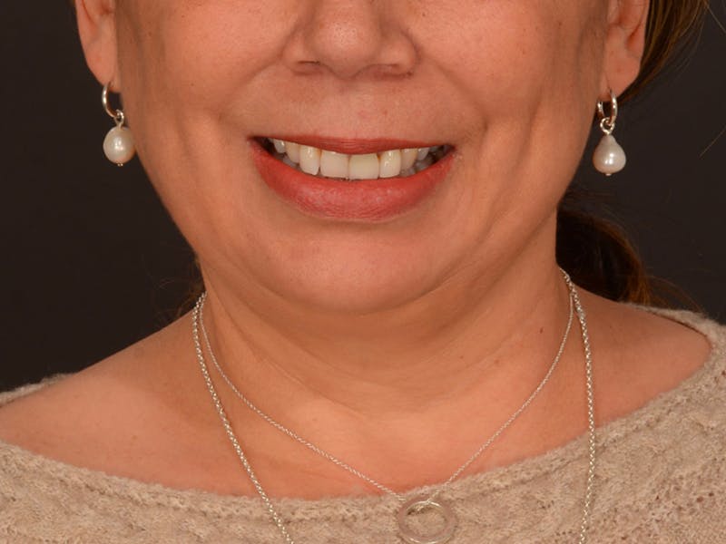 Chin Augmentation Before & After Gallery - Patient 204268 - Image 3