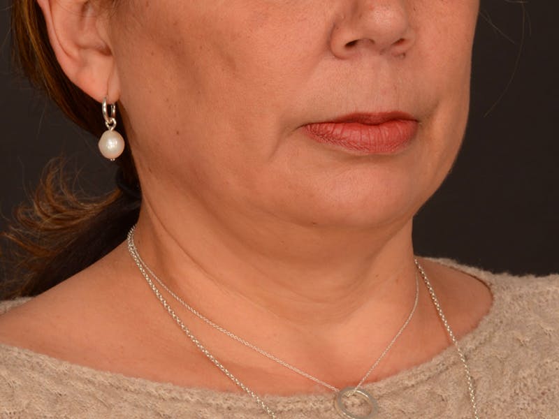 Chin Augmentation Before & After Gallery - Patient 204268 - Image 5