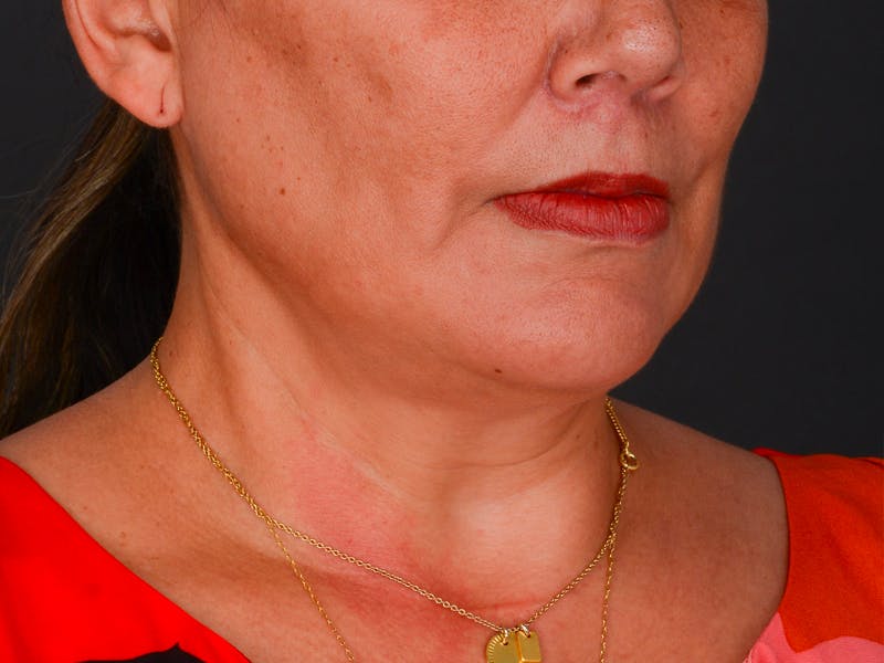 Chin Augmentation Before & After Gallery - Patient 204268 - Image 6