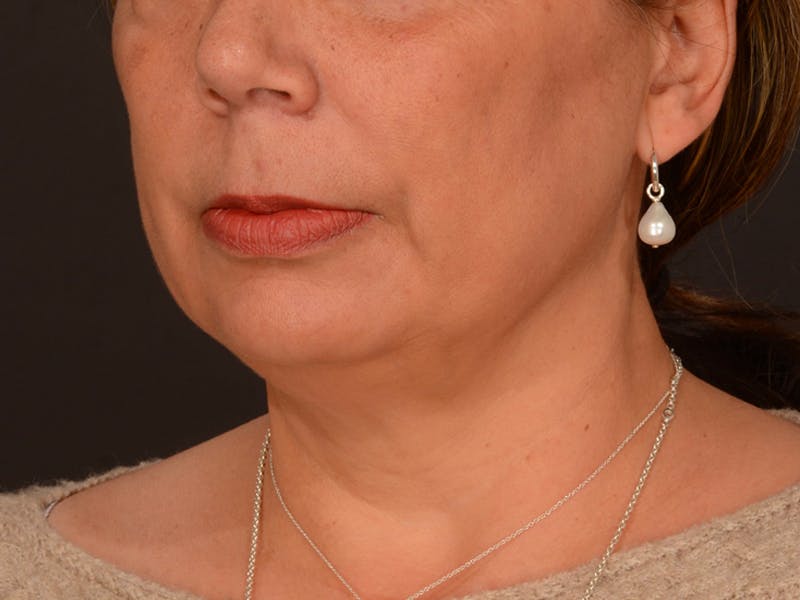 Chin Augmentation Before & After Gallery - Patient 204268 - Image 7