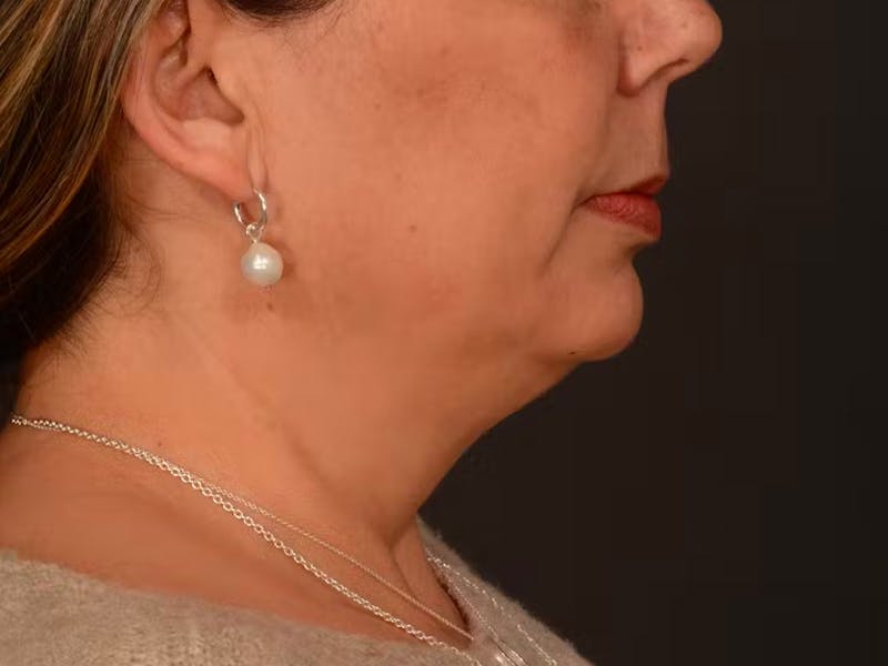 Chin Augmentation Before & After Gallery - Patient 204268 - Image 9