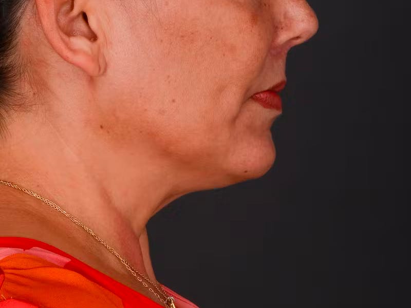 Chin Augmentation Before & After Gallery - Patient 204268 - Image 10