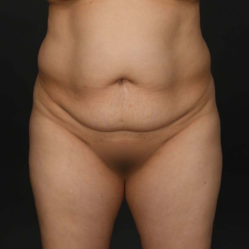 Tummy Tuck Before & After Gallery - Patient 415717 - Image 1
