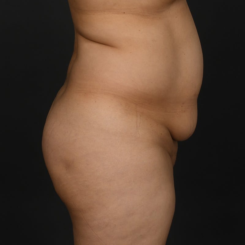 Tummy Tuck Before & After Gallery - Patient 415717 - Image 3