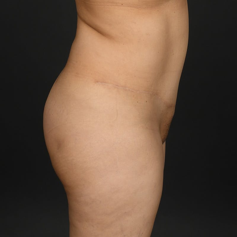 Tummy Tuck Before & After Gallery - Patient 415717 - Image 4