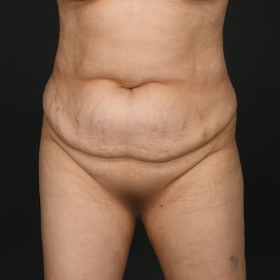 Tummy Tuck Before & After Gallery - Patient 347069 - Image 1