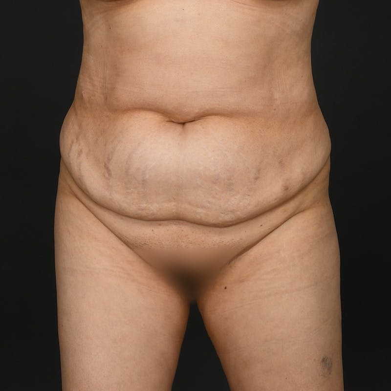 Tummy Tuck Before & After Gallery - Patient 347069 - Image 1