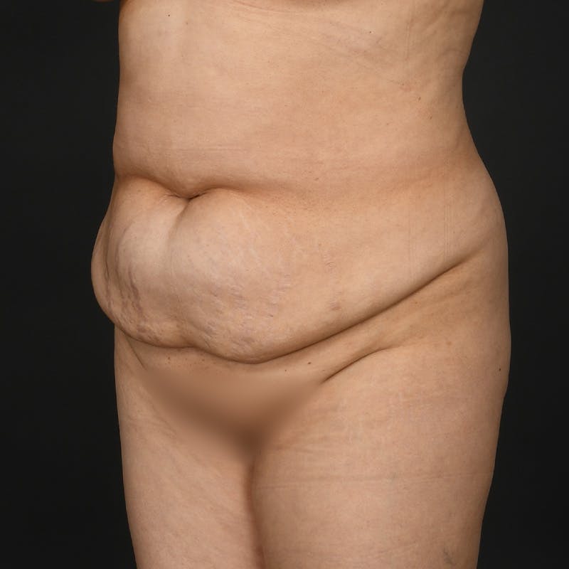 Tummy Tuck Before & After Gallery - Patient 347069 - Image 3