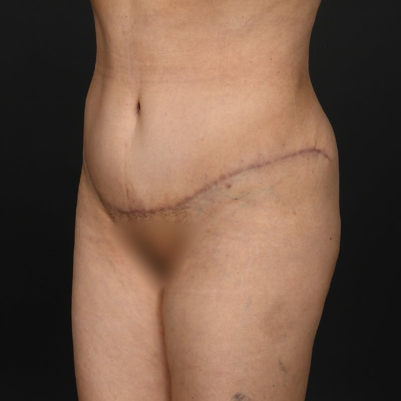 Tummy Tuck Before & After Gallery - Patient 347069 - Image 4