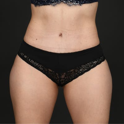 Tummy Tuck Before & After Gallery - Patient 365184 - Image 2