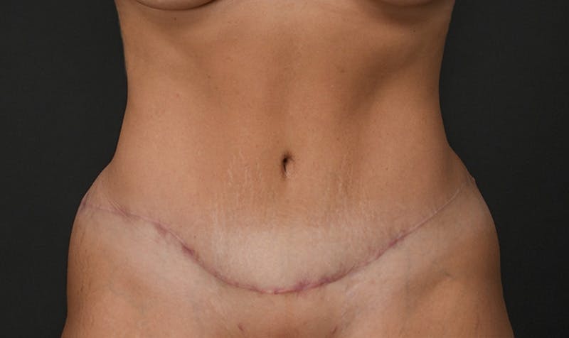 Tummy Tuck Before & After Gallery - Patient 354310 - Image 2