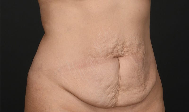 Tummy Tuck Before & After Gallery - Patient 354310 - Image 3