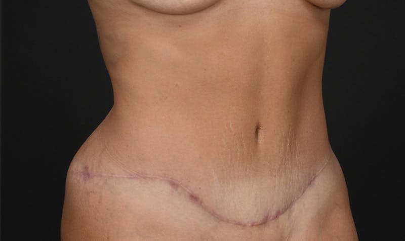Tummy Tuck Before & After Gallery - Patient 354310 - Image 4
