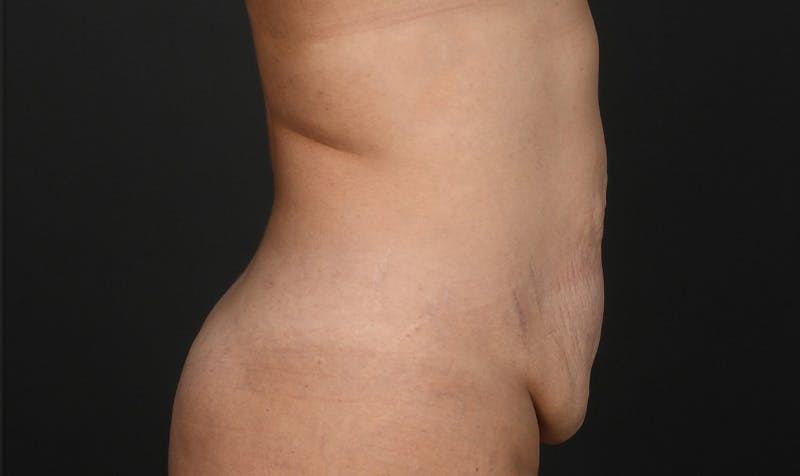 Tummy Tuck Before & After Gallery - Patient 354310 - Image 5