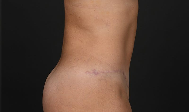 Tummy Tuck Before & After Gallery - Patient 354310 - Image 6