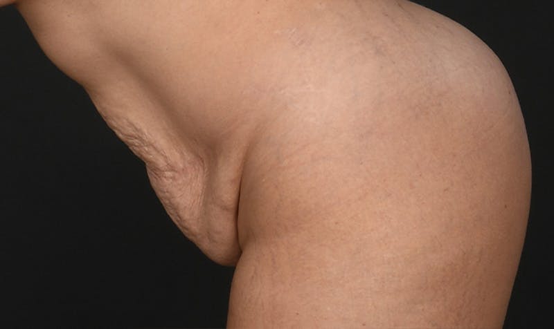 Tummy Tuck Before & After Gallery - Patient 354310 - Image 7