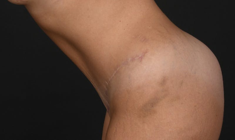 Tummy Tuck Before & After Gallery - Patient 354310 - Image 8