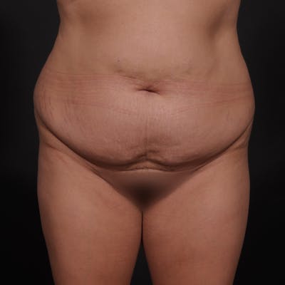 Tummy Tuck Before & After Gallery - Patient 238810 - Image 1