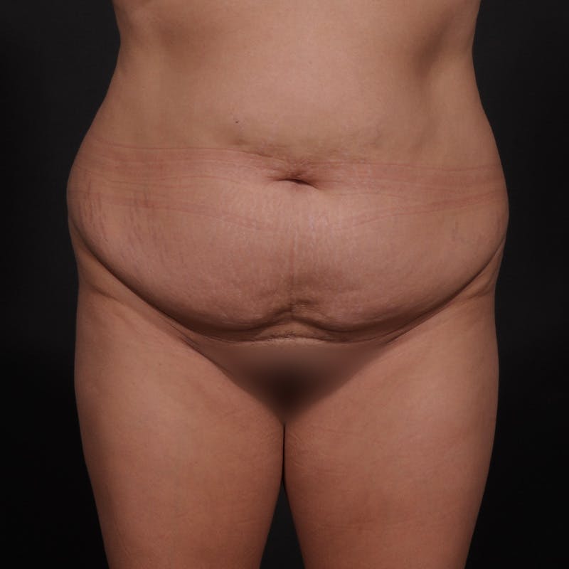 Tummy Tuck Before & After Gallery - Patient 238810 - Image 1