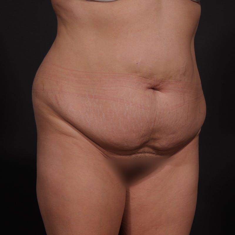 Tummy Tuck Before & After Gallery - Patient 238810 - Image 3