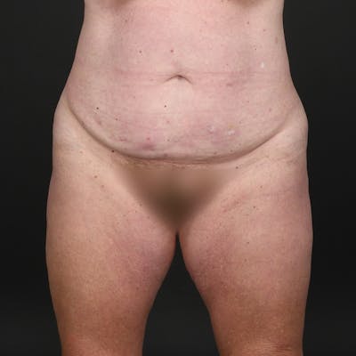Tummy Tuck Before & After Gallery - Patient 587569 - Image 1