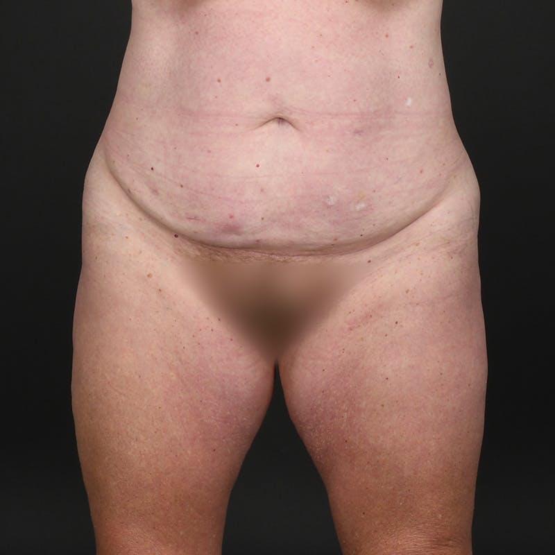 Tummy Tuck Before & After Gallery - Patient 587569 - Image 1