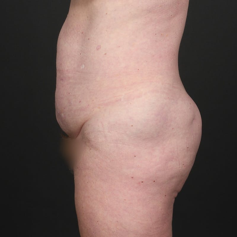 Tummy Tuck Before & After Gallery - Patient 587569 - Image 3