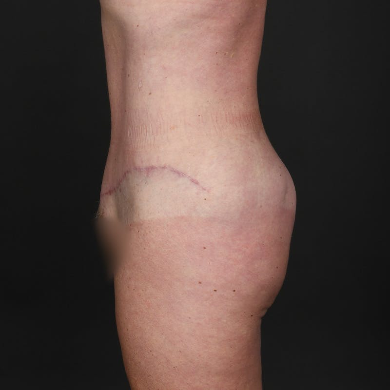 Tummy Tuck Before & After Gallery - Patient 587569 - Image 4