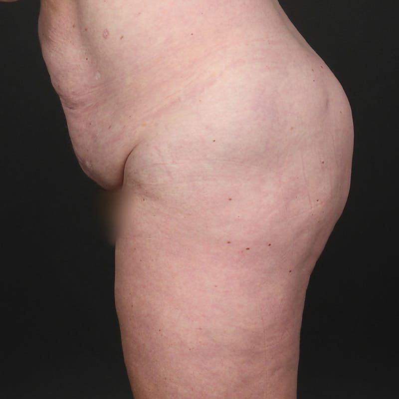 Tummy Tuck Before & After Gallery - Patient 587569 - Image 5