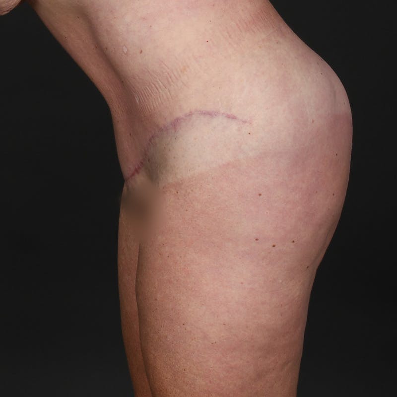 Tummy Tuck Before & After Gallery - Patient 587569 - Image 6