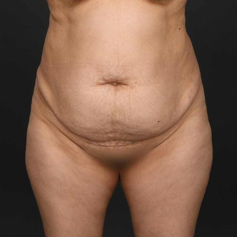 Tummy Tuck Before & After Gallery - Patient 277714 - Image 1