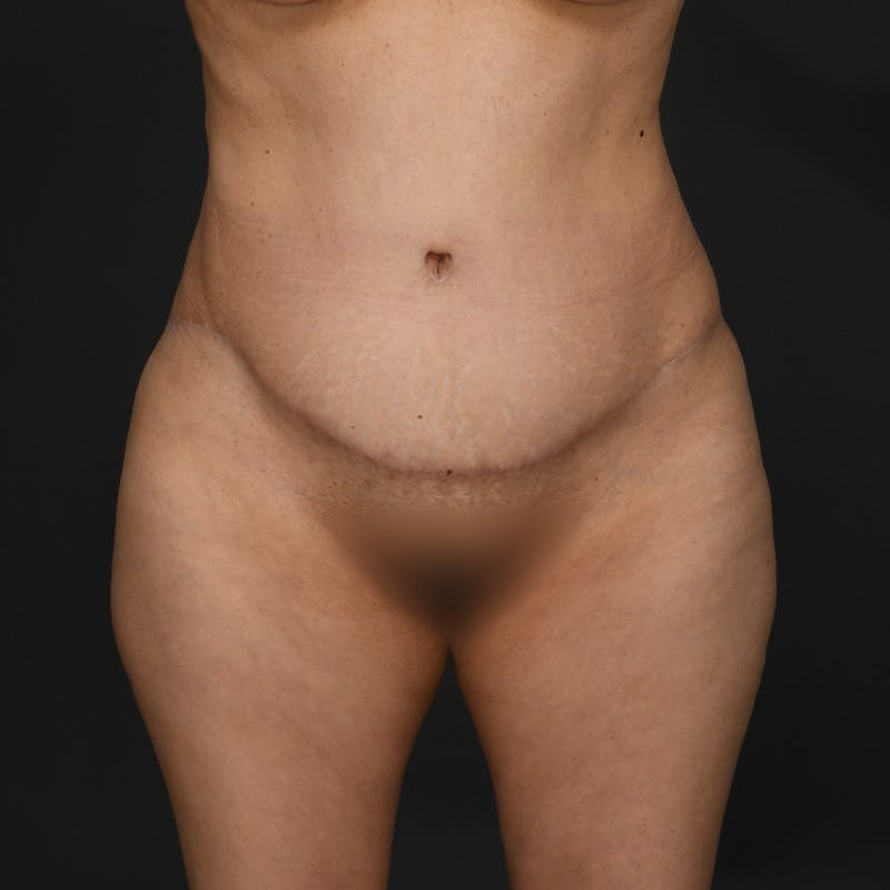 Tummy Tuck Before & After Gallery - Patient 277714 - Image 2