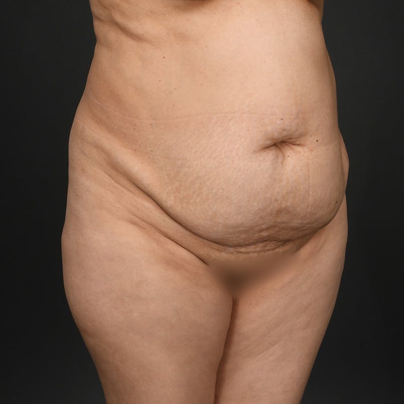 Tummy Tuck Before & After Gallery - Patient 277714 - Image 3