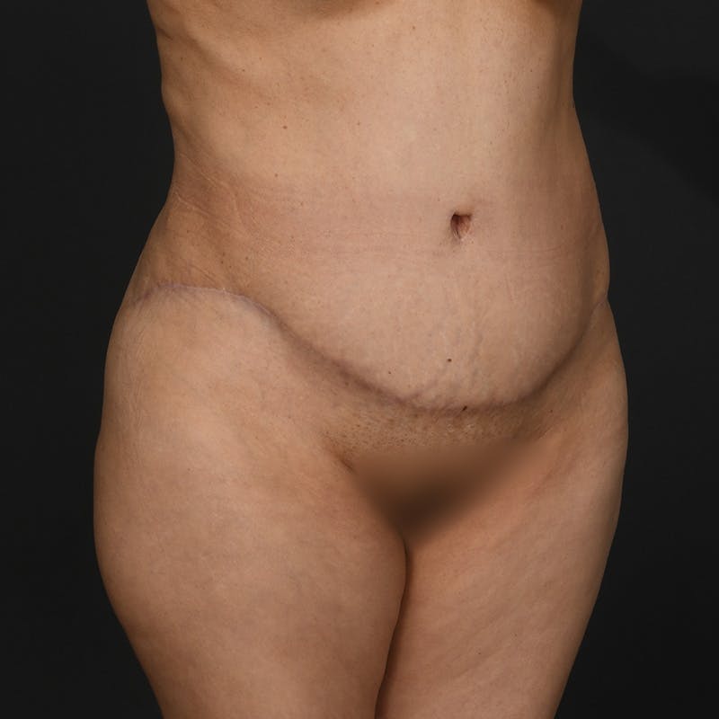 Tummy Tuck Before & After Gallery - Patient 277714 - Image 4
