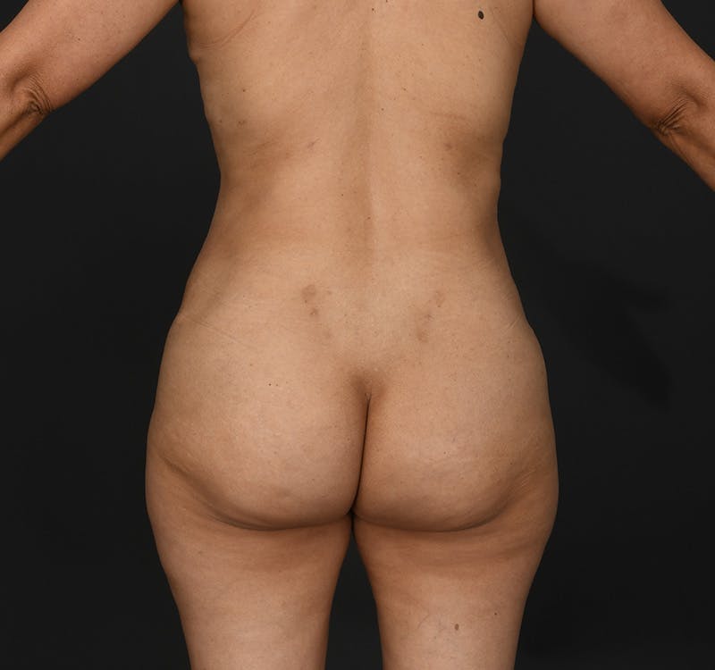 Tummy Tuck Before & After Gallery - Patient 277714 - Image 6