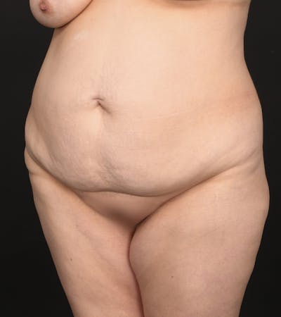 Tummy Tuck Before & After Gallery - Patient 151592 - Image 1